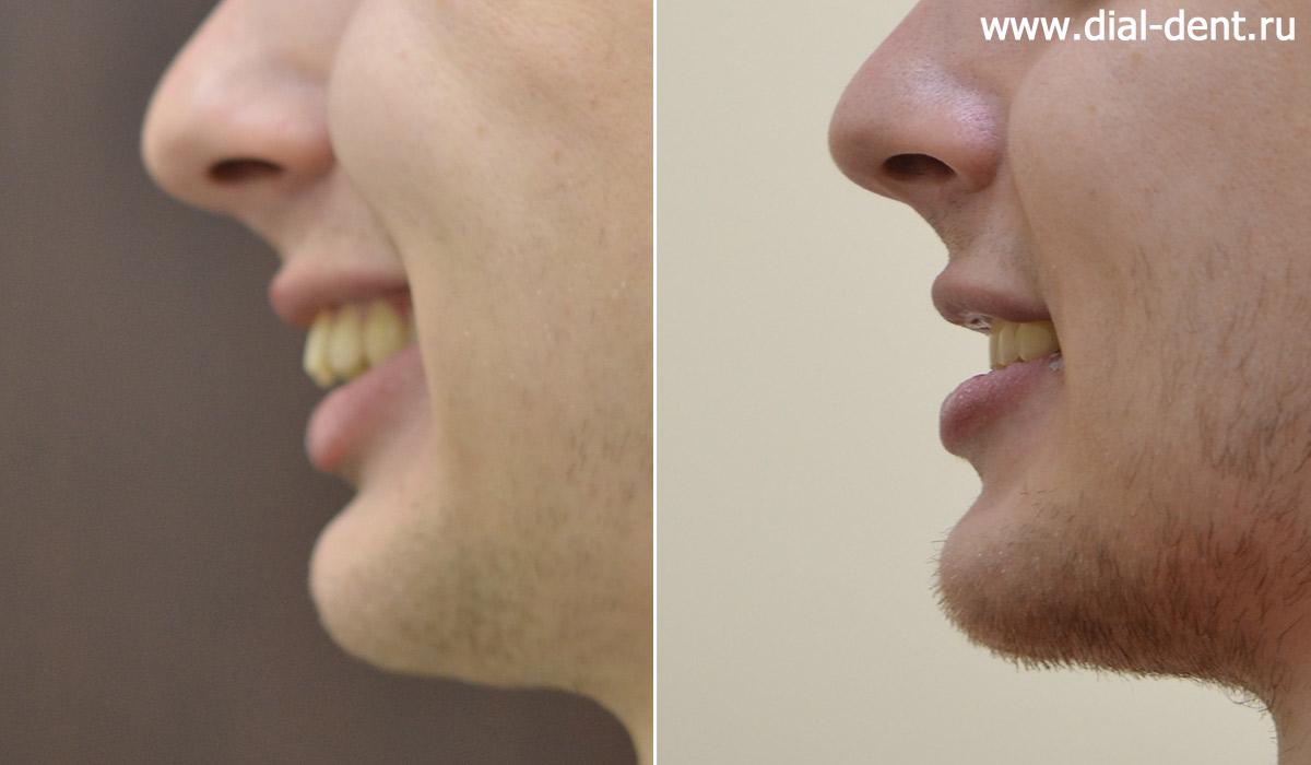 профиль до и после ортодонтического лечения