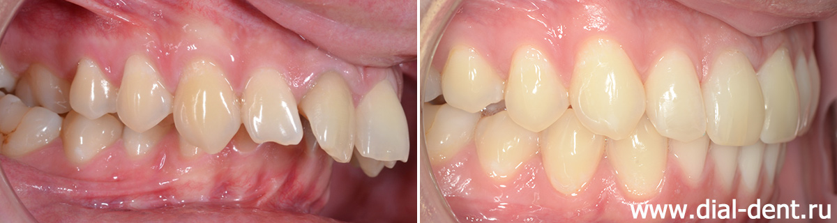 вид в прикусе справа до и после ортодонтического лечения