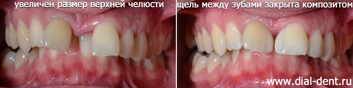 временная коррекция щели между передними зубами