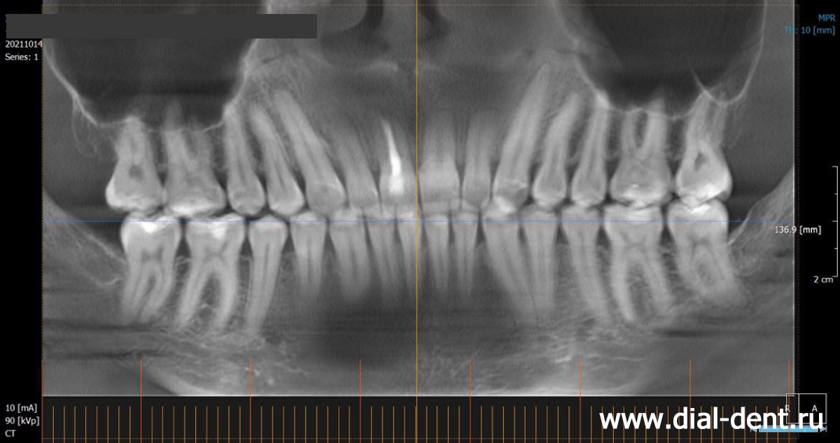 панорамный снимок зубов после хирургического исправления прикуса
