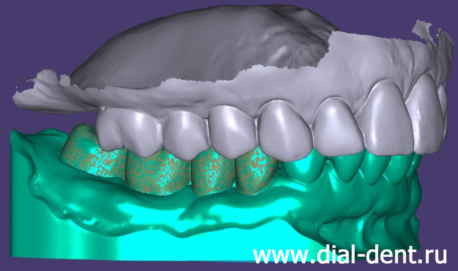 моделирование зубного протеза