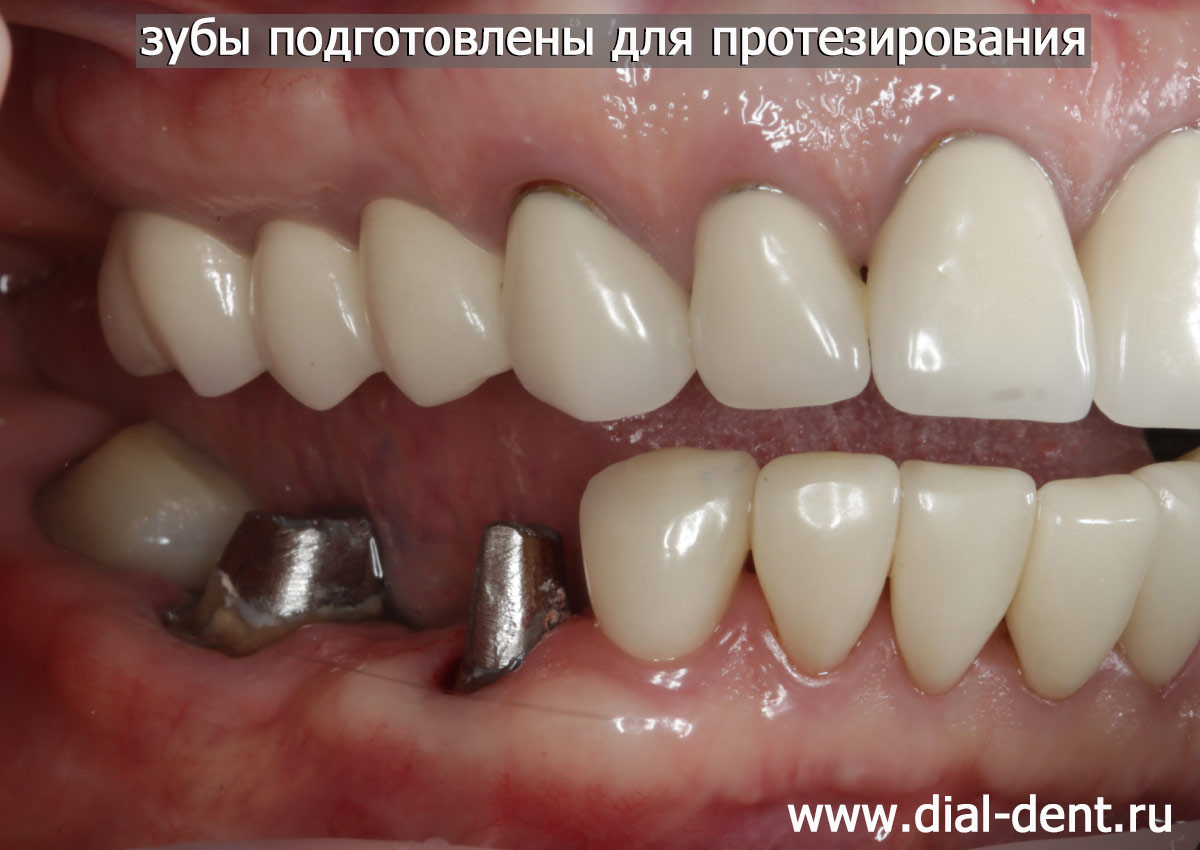 зубы подготовлены к протезированию