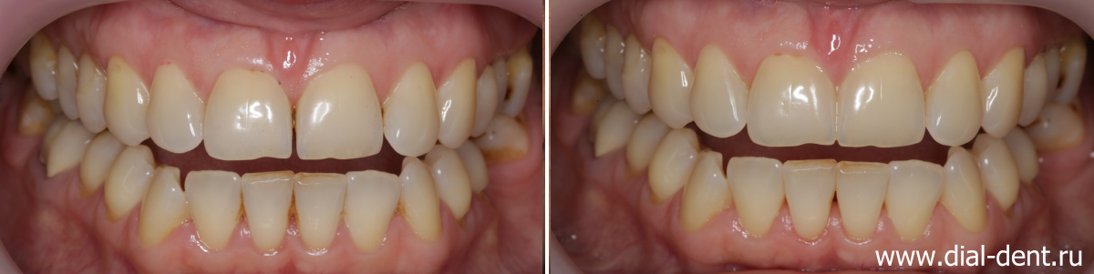 щель между передними зубами до и после лечения у миофункционального терапевта