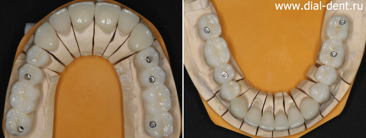 керамические зубные коронки и виниры на модели в лаборатории