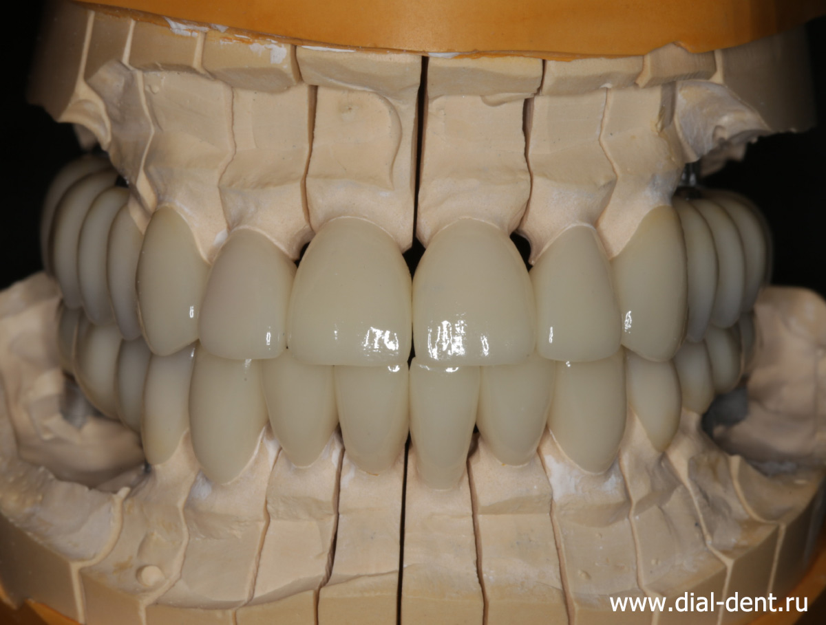 керамические зубные коронки и виниры на модели в лаборатории