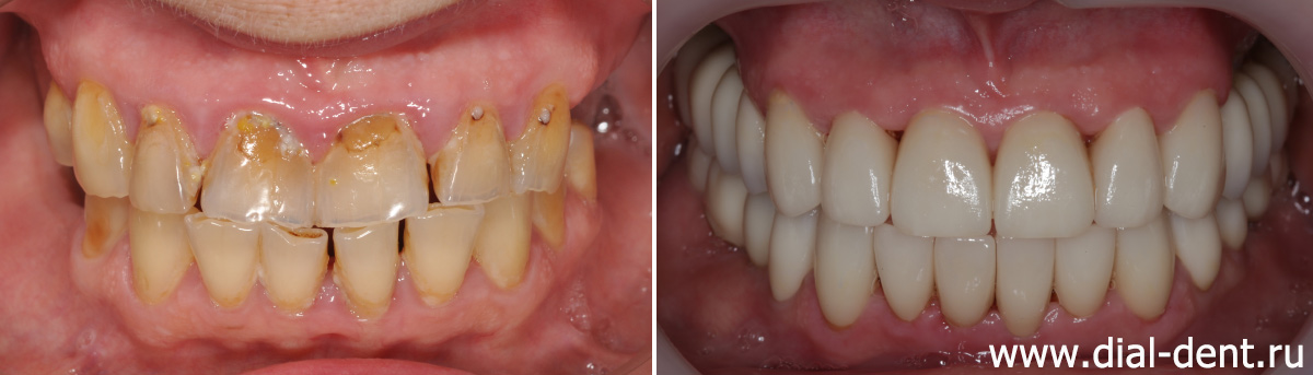 до и после имплантации и протезирования зубов керамикой