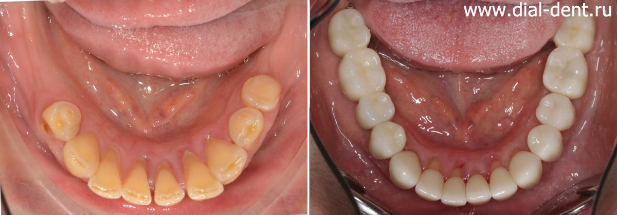 нижние зубы до и после имплантации и протезирования керамикой