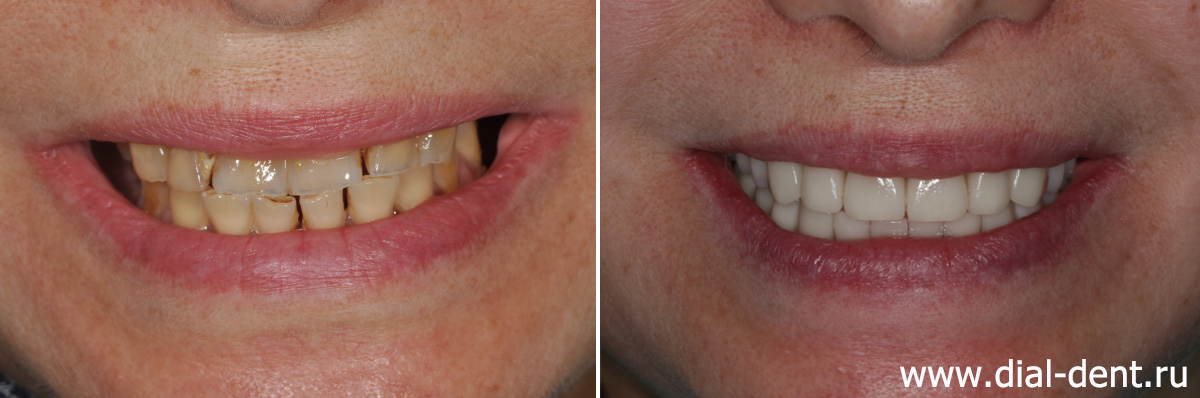 улыбка до и после имплантации и протезирования зубов