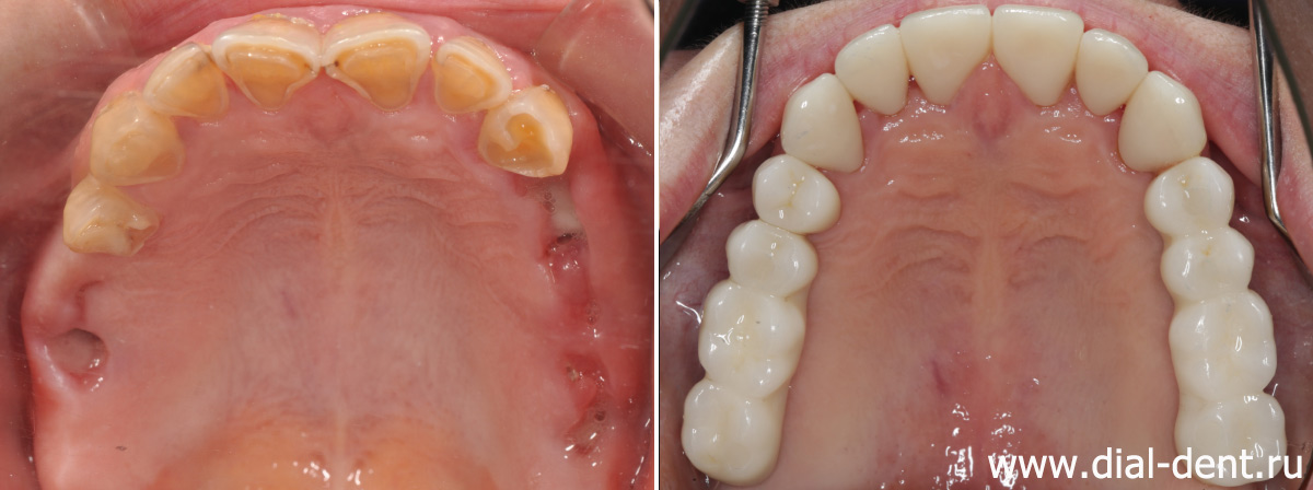 верхние зубы до и после имплантации и протезирования керамикой