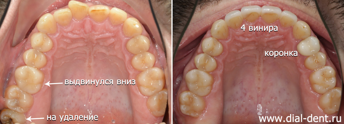 верхние зубы до и после комплексного лечения