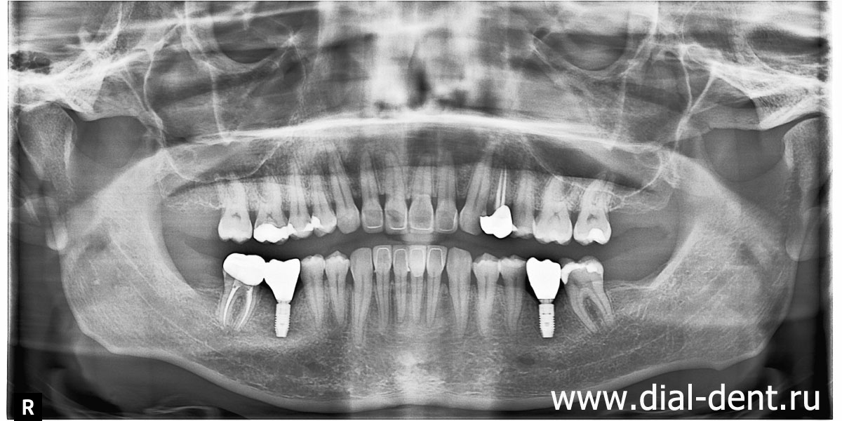 панорамный снимок зубов после окончания комплексного лечения