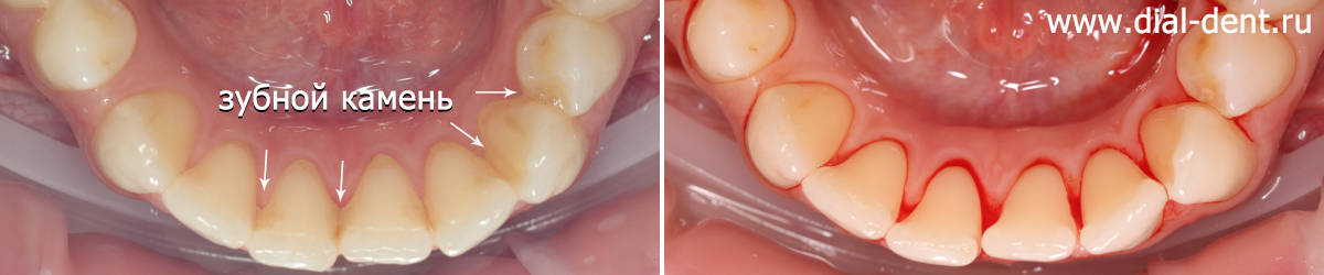 зубной камень на внутренней поверхности зубов полностью удален