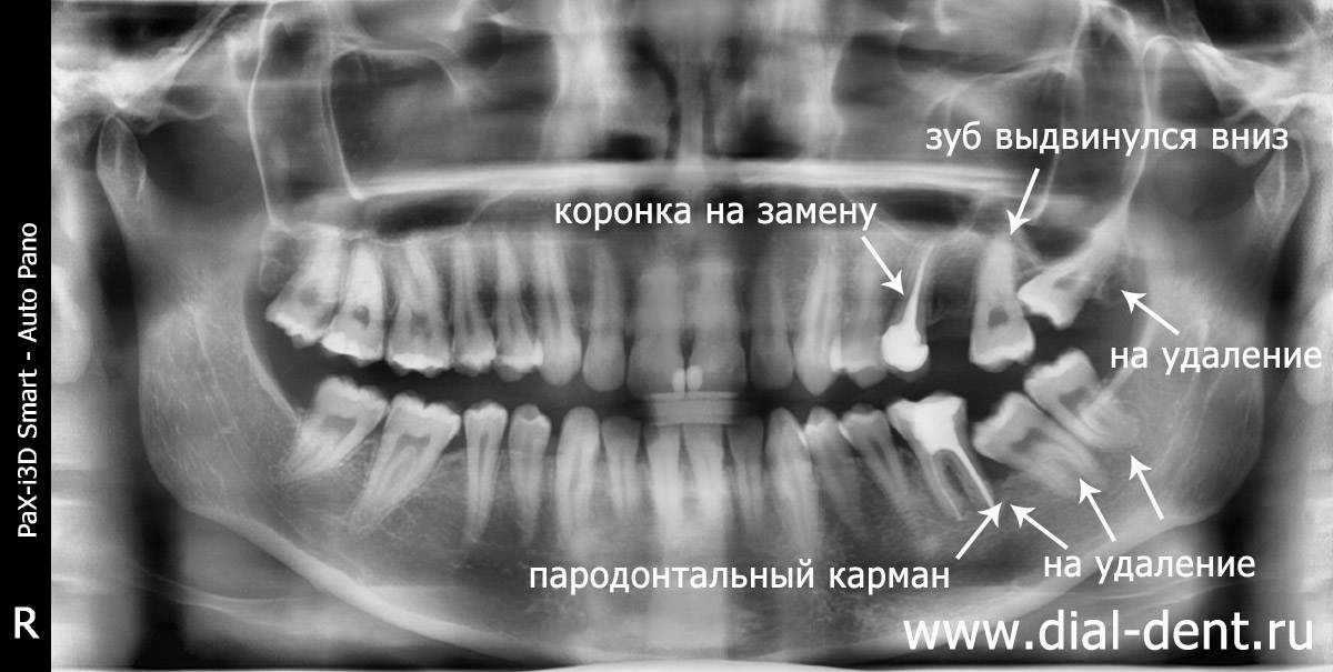 панорамный снимок зубов до протезирования
