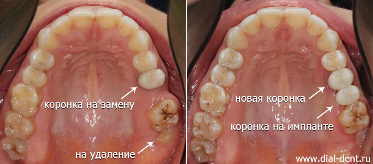 верхние зубы до и после имплантации и протезирования