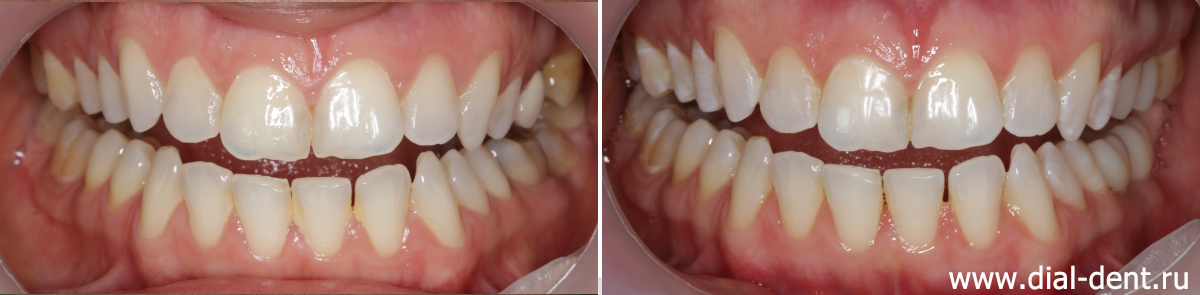 вид до и после имплантации и протезирования жевательных зубов
