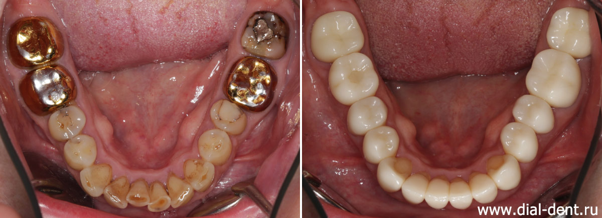 нижние зубы до и после имплантации и протезирования