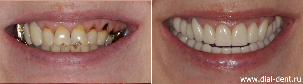 до и после имплантации и протезирования зубов в Диал-Дент