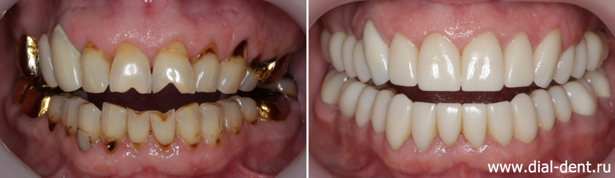 вид до и после имплантации и реставрации всех зубов керамикой