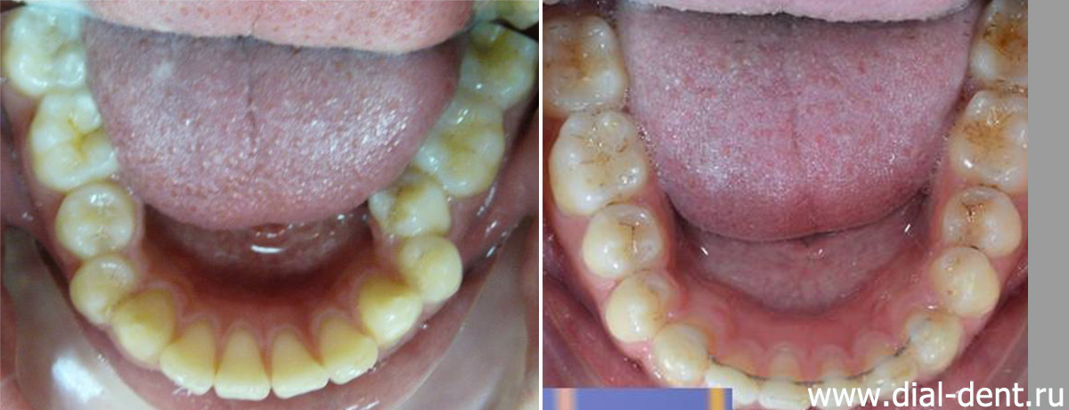 нижние зубы до и после исправления прикуса