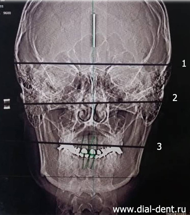 телерентгенограмма головы в прямой проекции