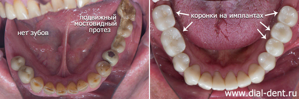 до и после лечения зубов с микроскопом, имплантации и протезирования зубов 