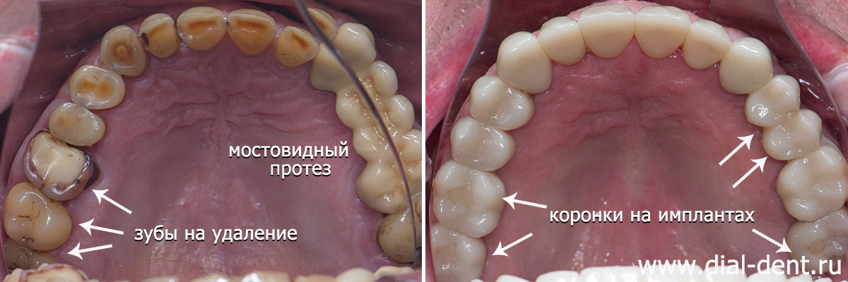 до и после лечения зубов с микроскопом, имплантации и протезирования зубов 