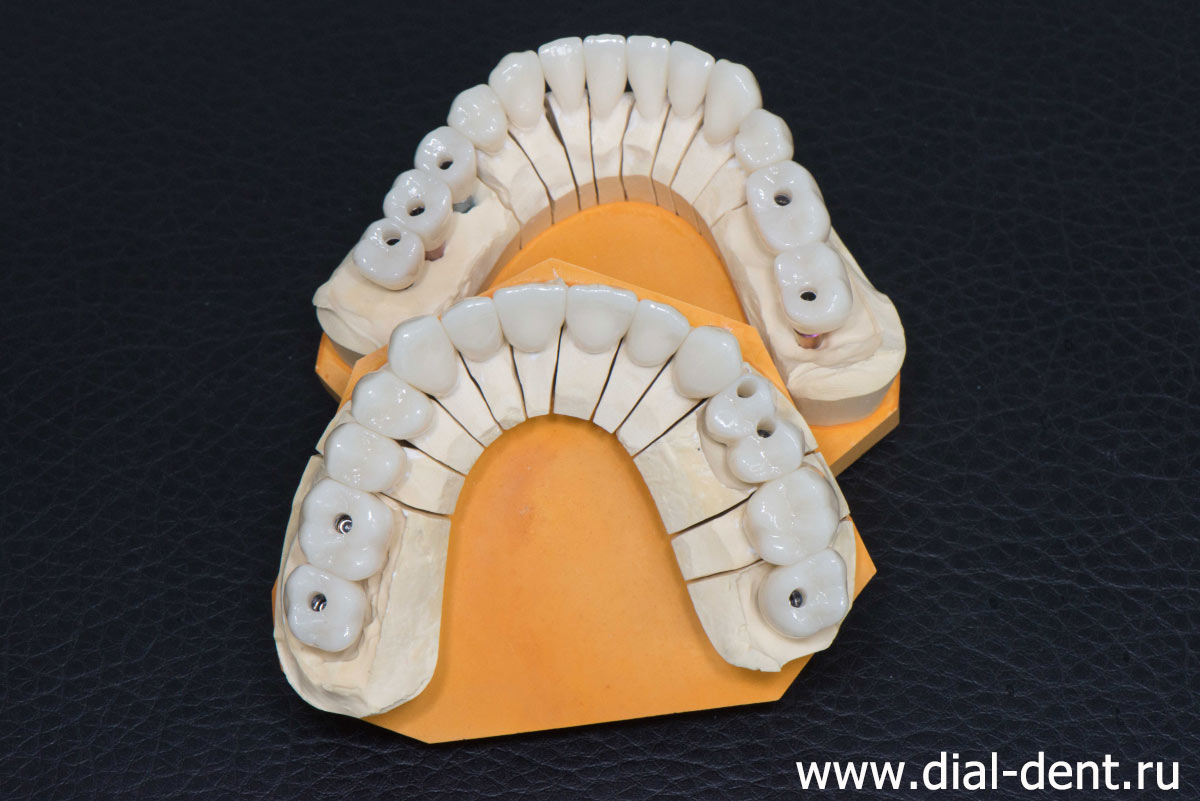 керамические зубные коронки диоксид циркония