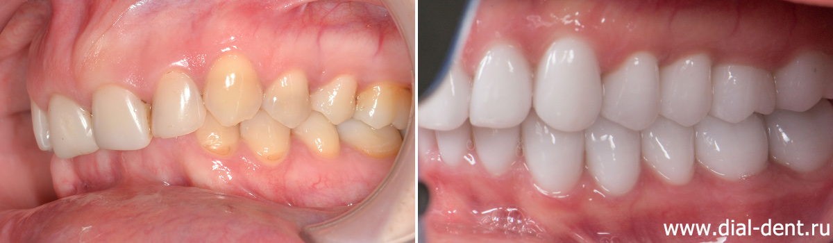 вид зубов слева до и после лечения