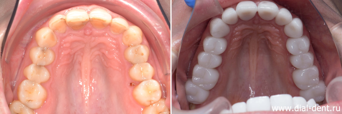 вид верхних зубов до и после лечения