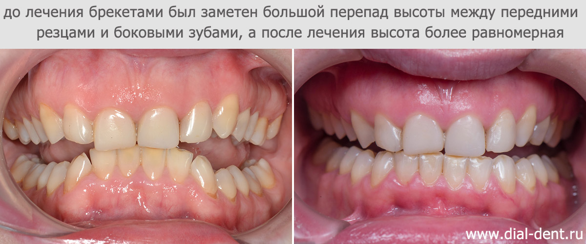 выровнена высота нижних зубов в дуге