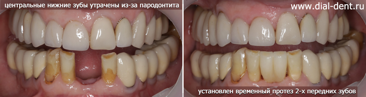 вид при обращении и после протезирования передних нижних зубов