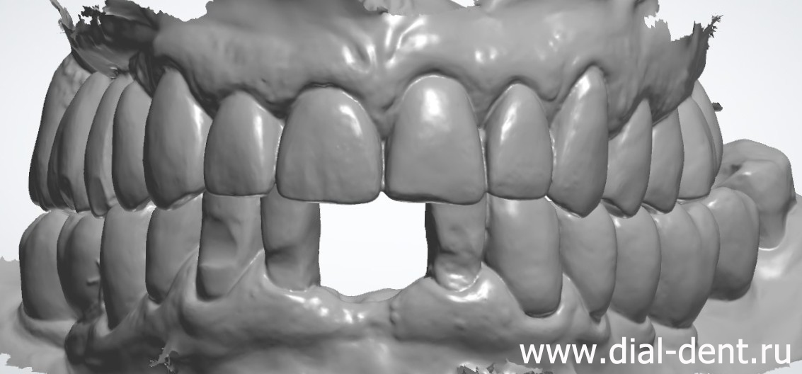 цифровое сканирование зубов