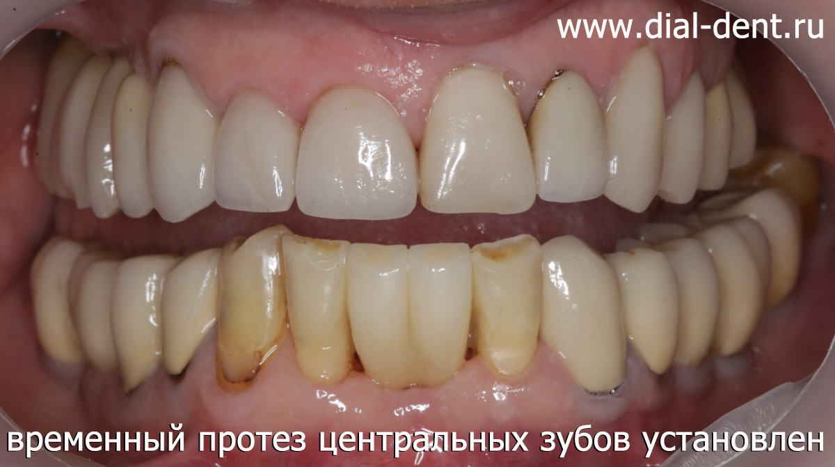 временный протез двух нижних центральных зубов