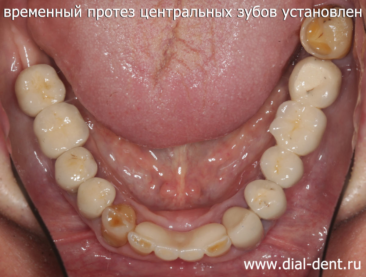временный протез центральных нижних зубов установлен