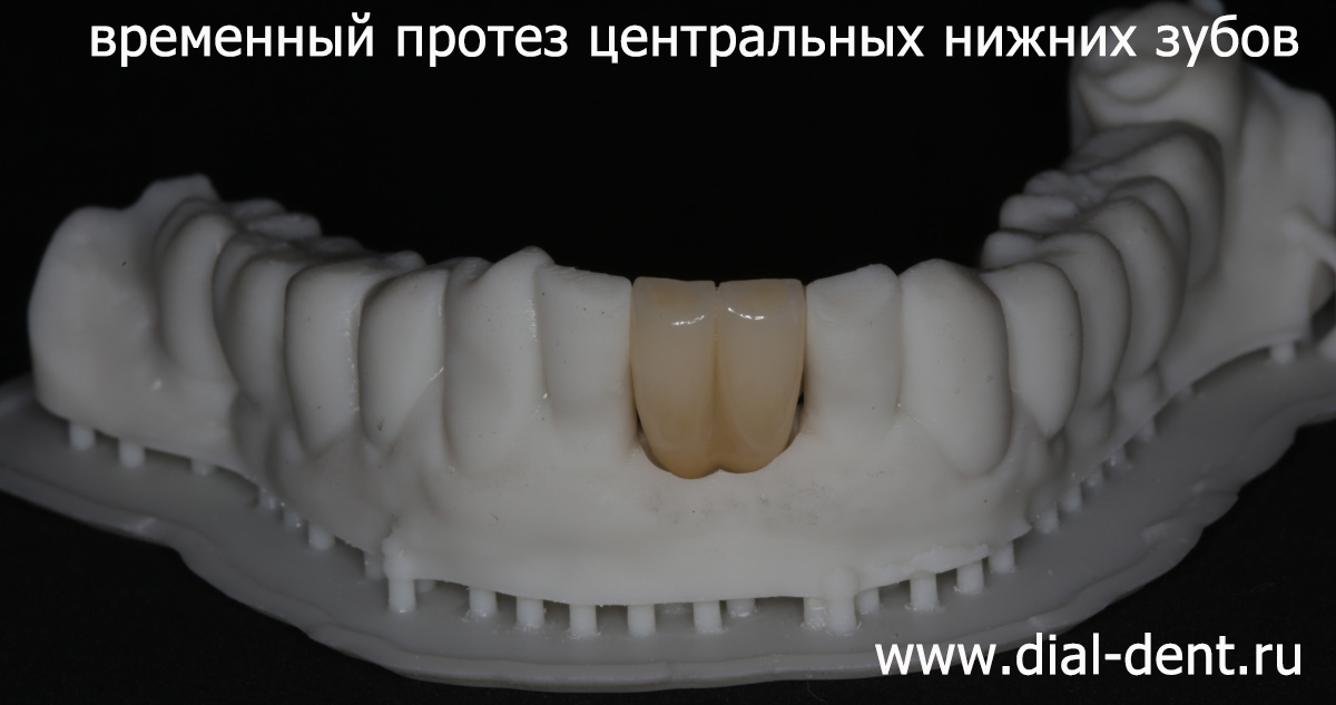 керамический протез двух центральных нижних зубов