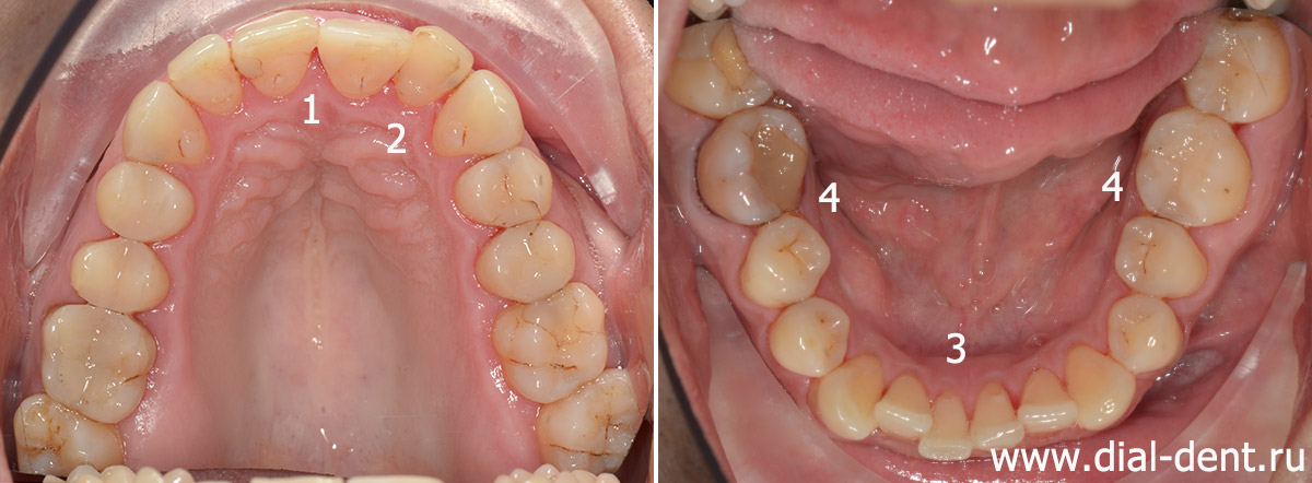ортодонтические проблемы пациента до начала лечения