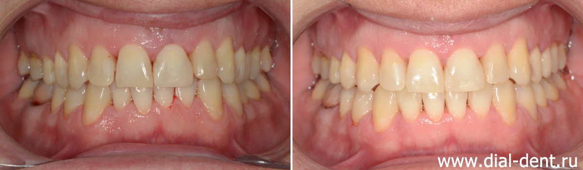 до и после ортодонтического лечения капами 3D Smile