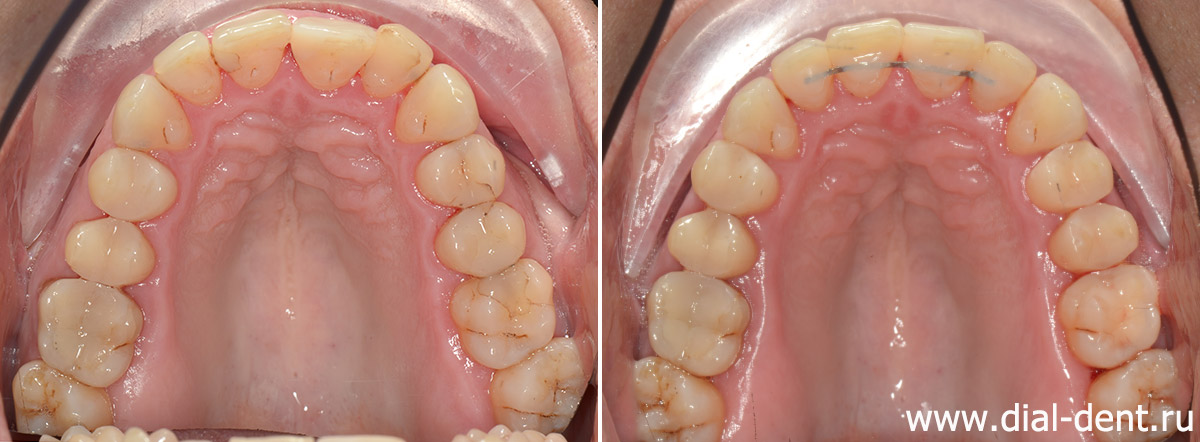 верхние зубы до и после ортодонтического лечения капами 3D Smile