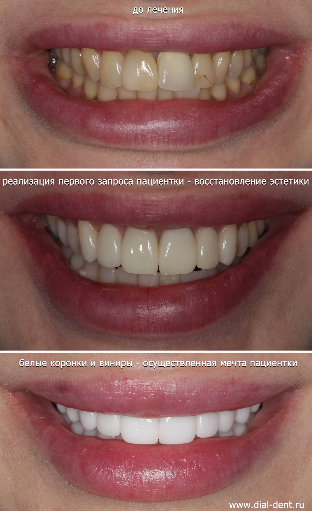 до и после протезирования зубов