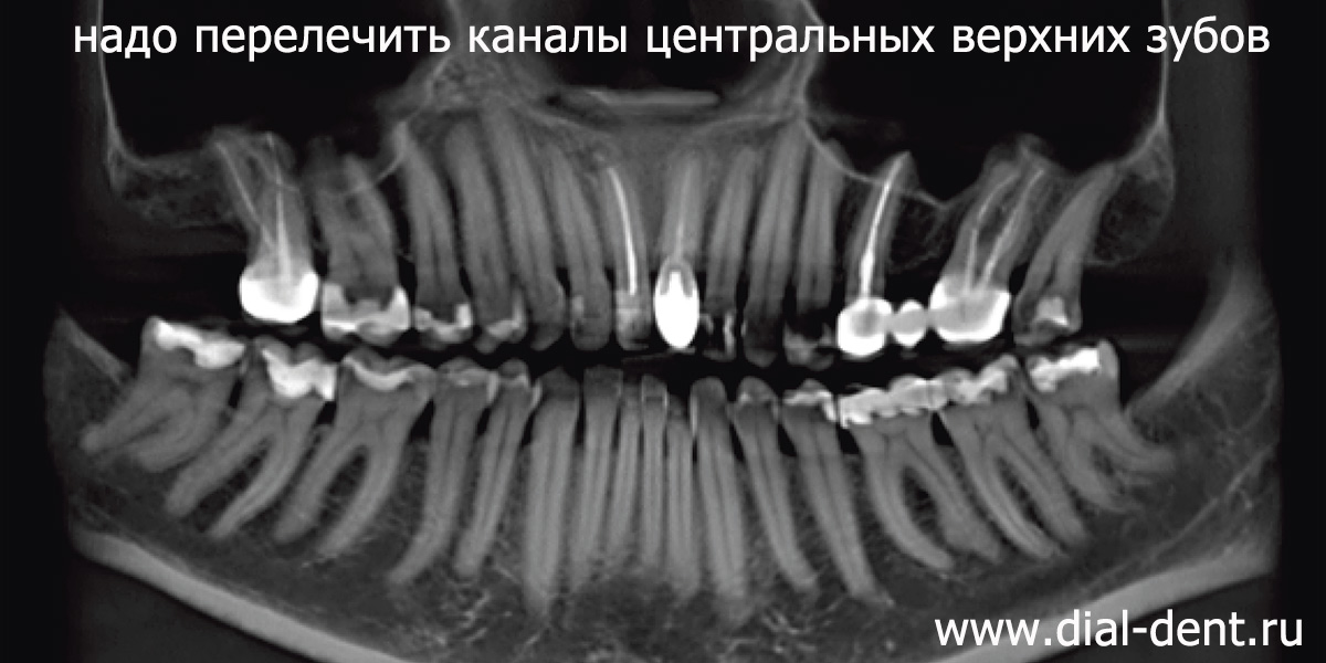 панорамный снимок зубов до лечения