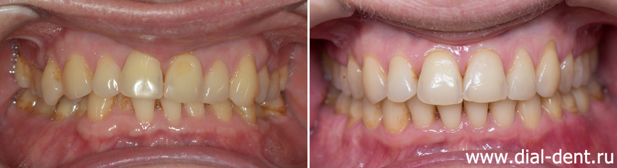 до и после лечения брекетами, реставрации передних зубов и протезирования одного зуба на импланте
