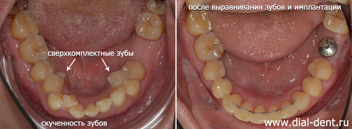 результат лечения брекетами - нижние зубы