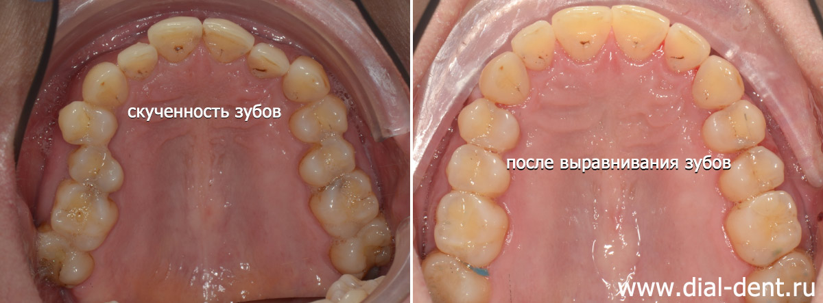до и после лечения верхние зубы
