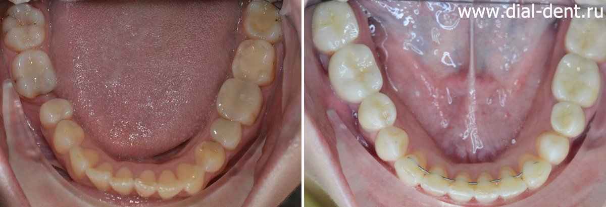 нижние зубы до и после лечения - закрыта щель между зубами