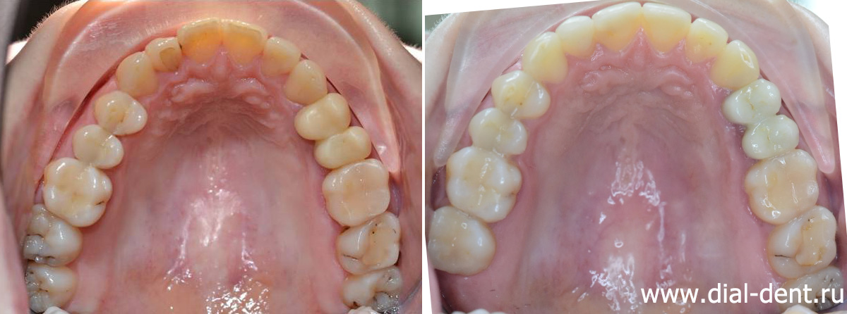 верхние зубы до и после лечения