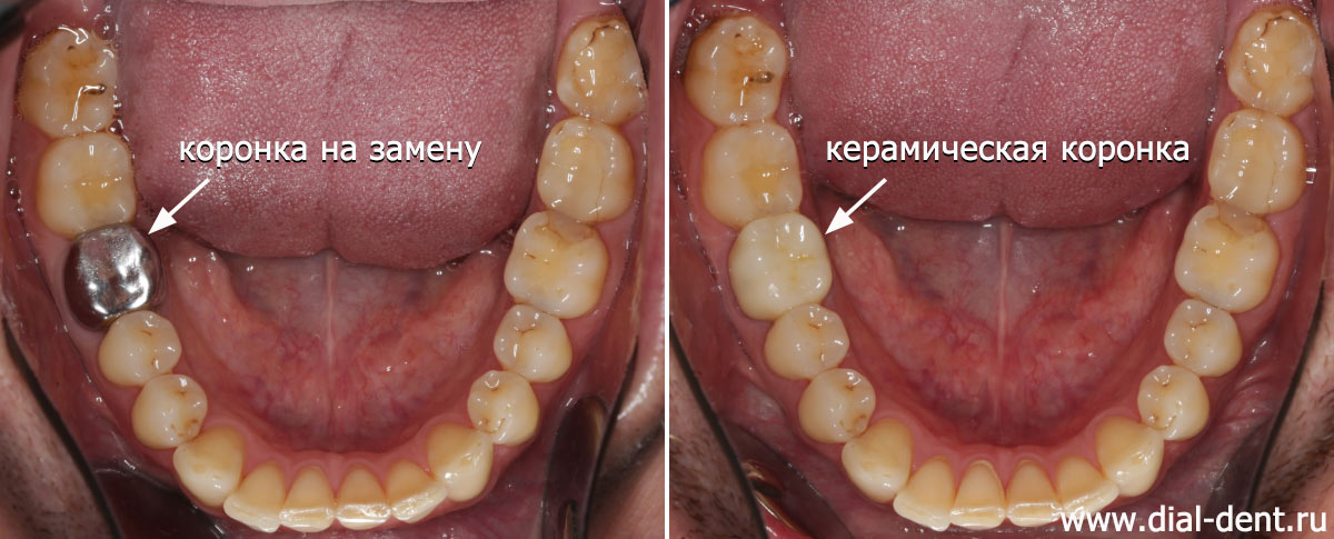 коронки на нижних зубах до и после замены