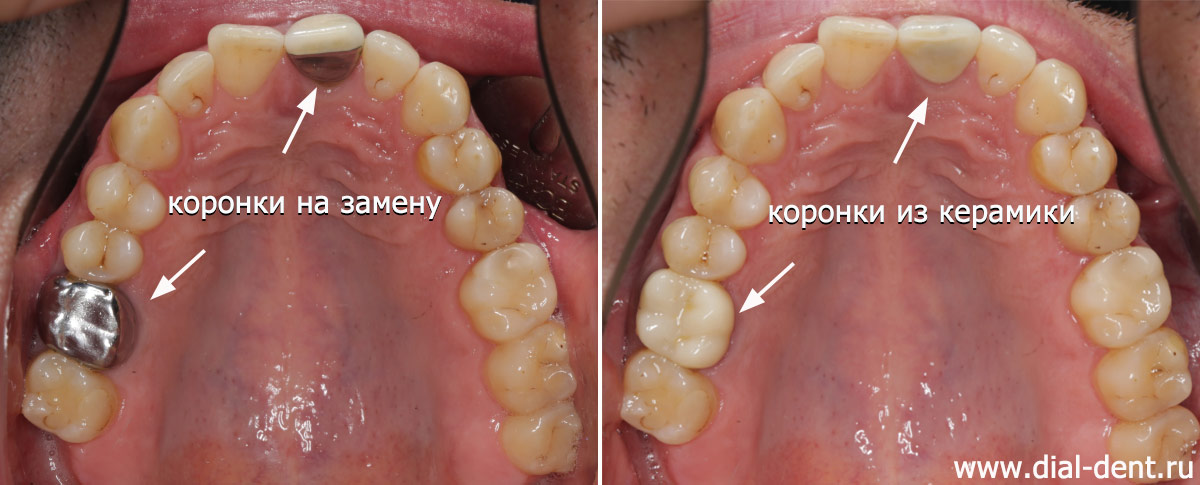 коронки на верхних зубах до и после замены