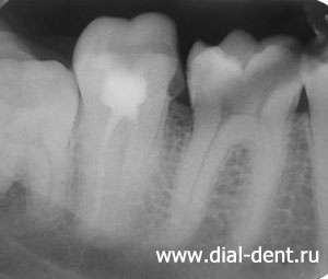 рентген зубов до лечения