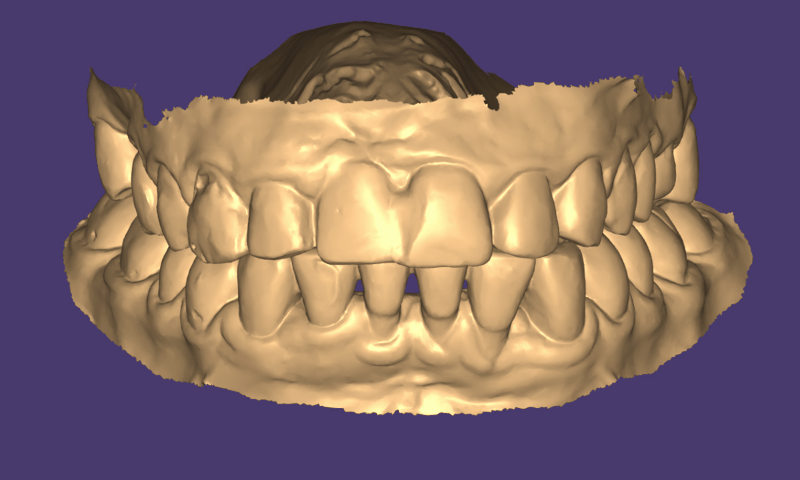 компьютерное моделирование на основании сканирования зубов