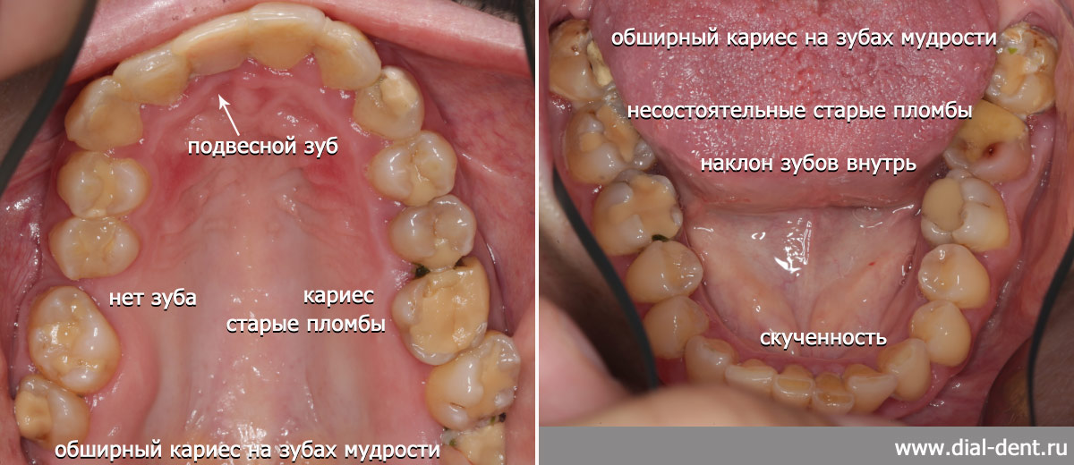 исходное состояние зубов